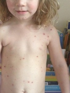 Chicken Pox