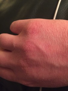 Dry, cracked skin on hands