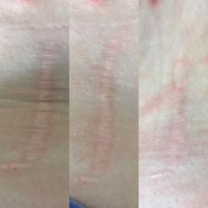 Side-by-side comparison of a scar before and after scar release therapy. The ‘before’ image shows a tight, raised scar, while the ‘after’ image shows smoother, more flexible skin.
