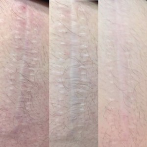 Another before-and-after comparison of a scar treated with scar release therapy. The ‘before’ image shows restricted tissue, while the ‘after’ image highlights improved skin texture and movement.