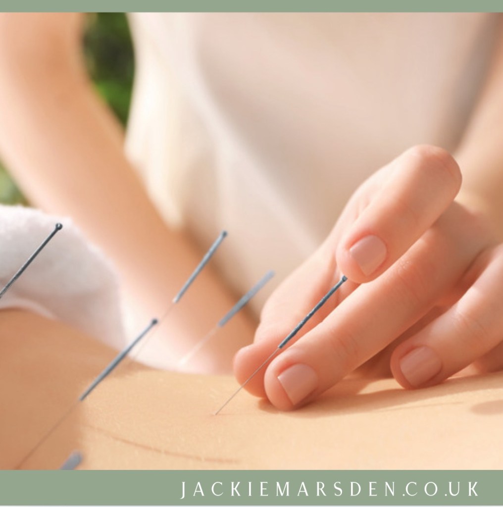 Fertility acupuncture in abdomen.